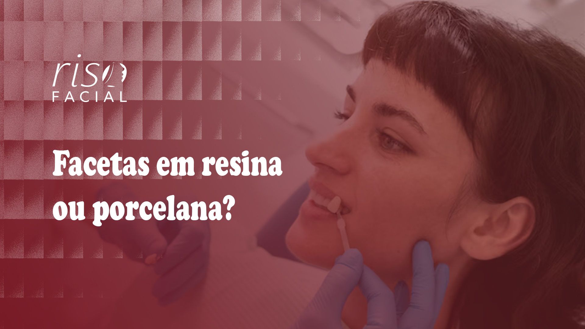 Imagem de capa: Facetas em resina ou porcelana