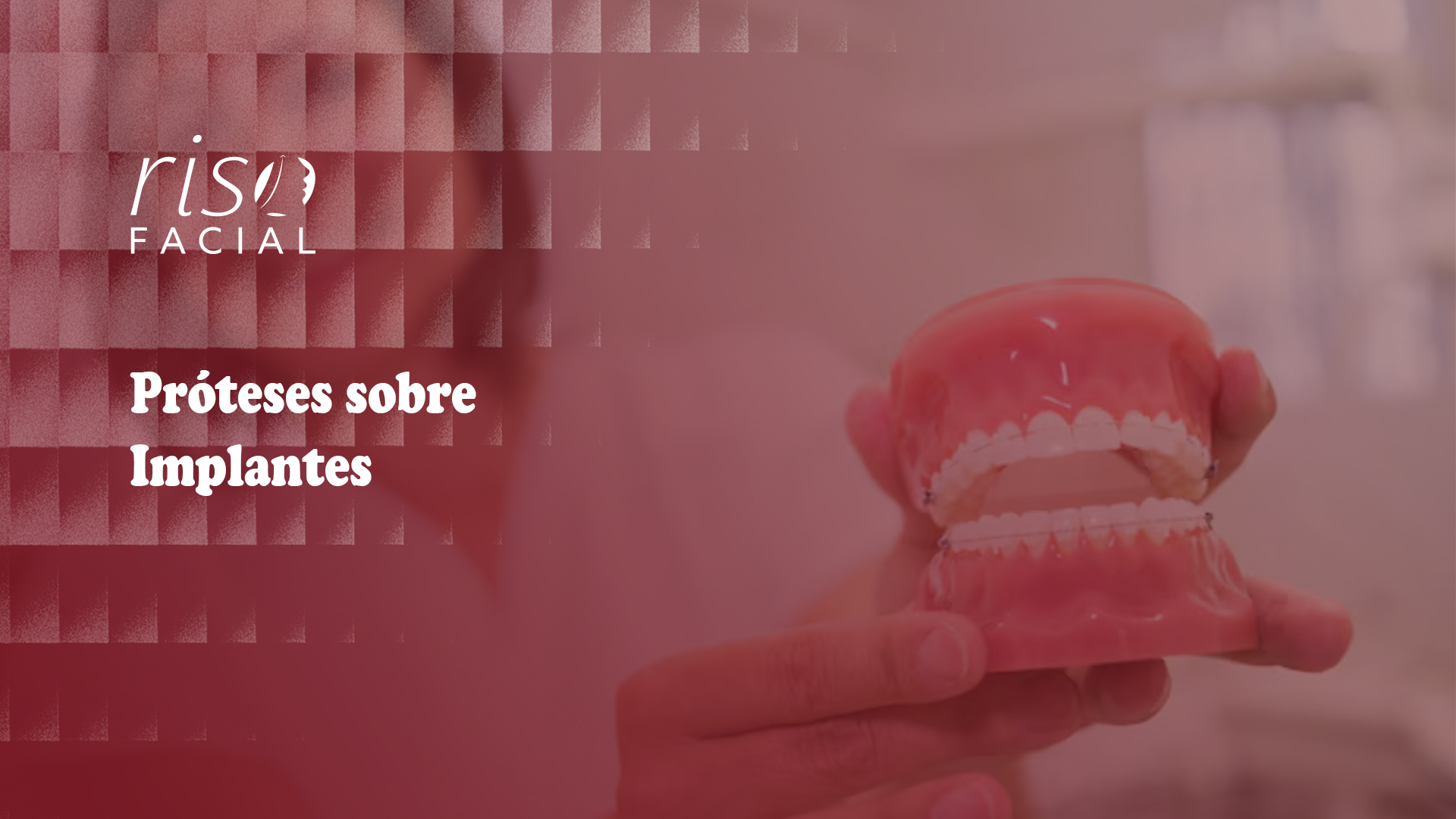 Imagem de capa: Próteses sobre Implantes