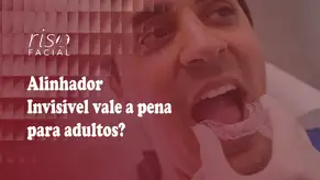 Alinhador invisível sendo colocado