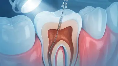 Ilustração 3D de tratamento de canal (endodontia) na Riso Facial